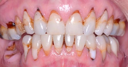Close up of mouth with severely decayed and damaged teeth