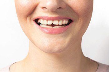 We can help you restore a cavity or broken tooth near Wharton, NJ