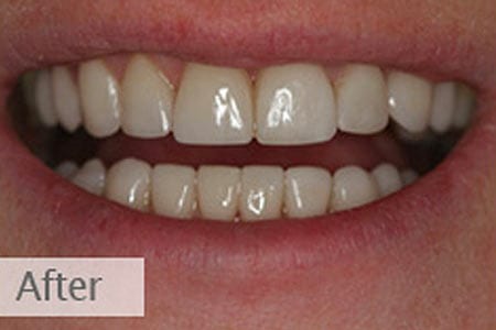 Close up of smile with bright white teeth