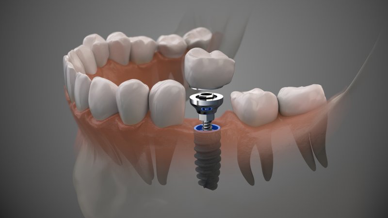 digital model of mouth with dental implant