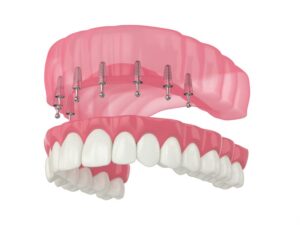 Digital illustration of a snap-on denture