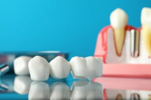 Custom dental bridge sitting on mirror table in front of dental implant model