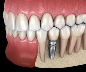 Single Dental Implants in Succasunna, NJ 