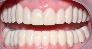 After crooked teeth treatment