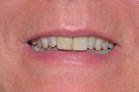 Before dentistry at Morris County Dental Associates, LLC