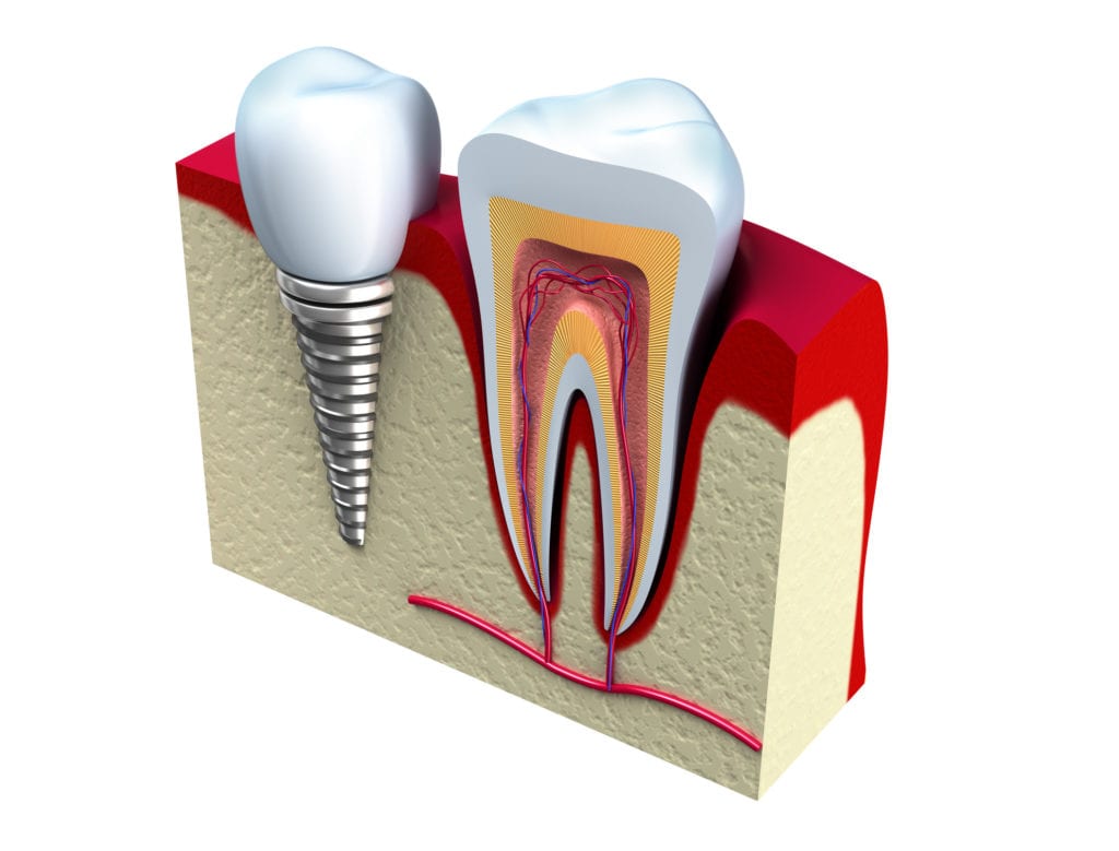 Dental Implants in Succasunna NJ
