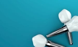 dental implants for missing teeth in Succasunna, new jersey