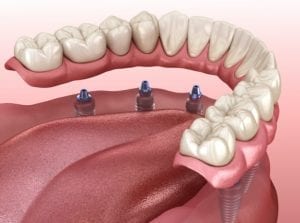 Dental Implant Overdentures in Succasunna, New Jersey
