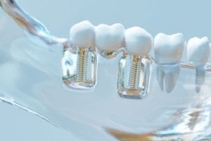 same day dental implants in Succasunna New Jersey