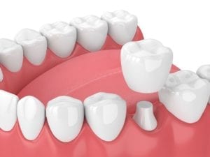 dental crowns and caps benefits in Succasunna New Jersey