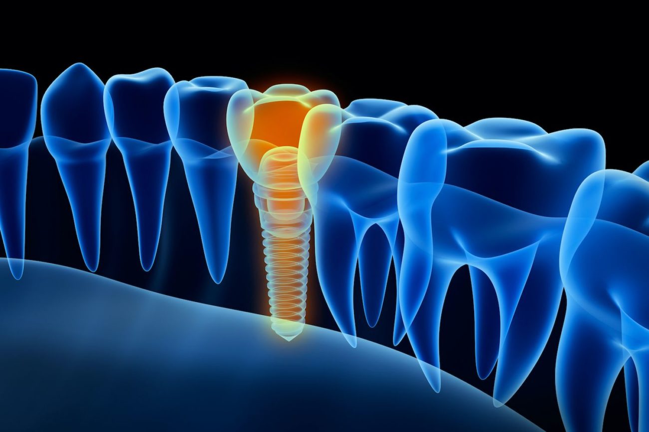 new dental implant technology in Succasunna New Jersey