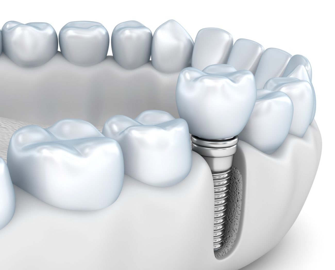 implant dentistry treatment Succasunna New Jersey