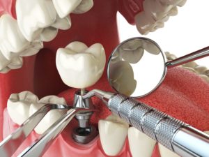 Identifying the Dental Implant Abutment