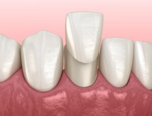 Can Porcelain Veneers Help Oral Health